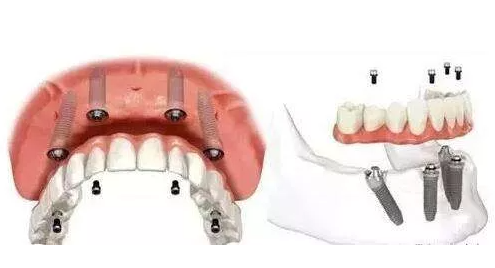 杭州美莱口腔种牙记0705