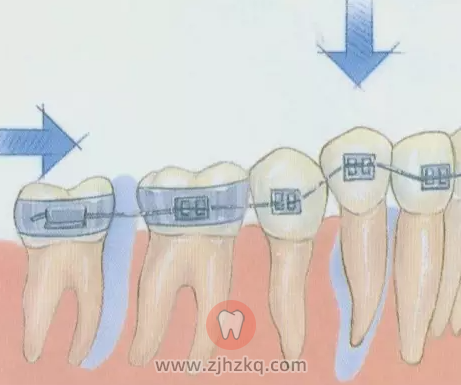 正畸和种牙可以同时进行吗？