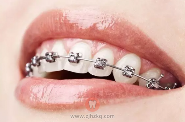 矫正牙齿正畸期间吃什么？
