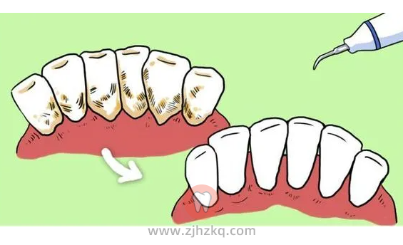 矫正牙齿正畸期间可以洗牙吗？