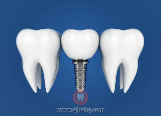 杭州牙齿种植牙如何维护保养？