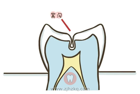 杭州窝沟封闭科普知识汇总