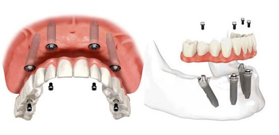 杭州种植牙手术一般要花多长时间？