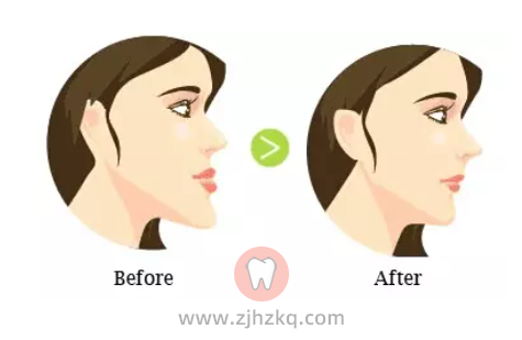 什么是牙颌畸形有哪些种类和图片