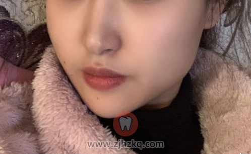 杭州拔埋伏牙阻生智齿看牙记1218