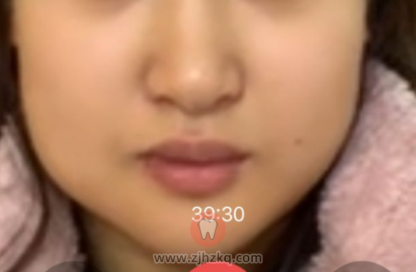 杭州拔埋伏牙阻生智齿看牙记1218