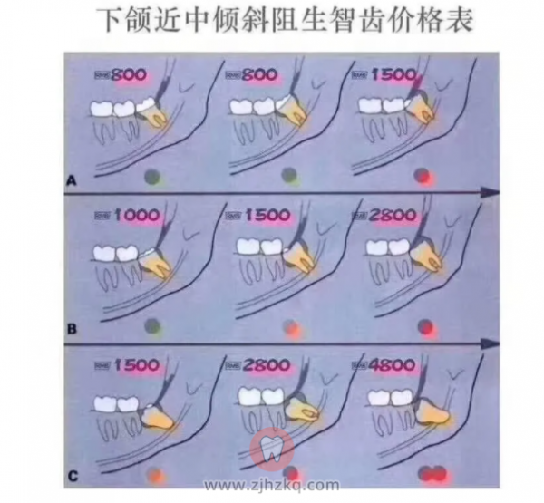 杭州**拔智齿2900元一颗为啥这么贵？