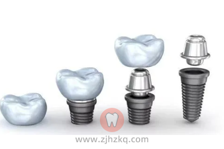 杭州种植牙攻略杭州种牙防坑指南