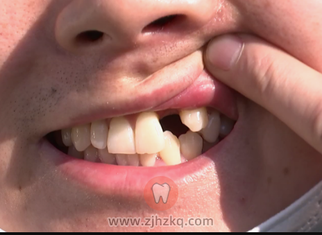 杭州美奥口腔看牙记0528