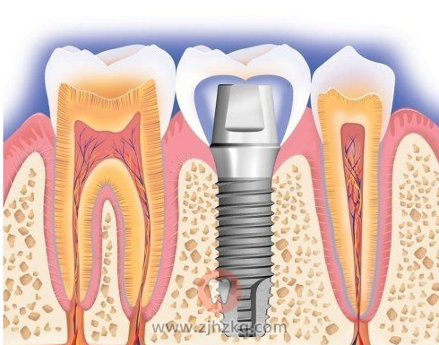 杭州种牙记我的种植牙手术亲身经历
