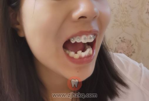 杭州牙齿矫正戴金属自锁矫正要花多少钱？