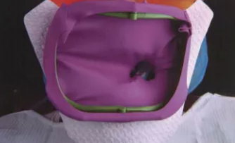 看牙时放进嘴巴里的橡皮障是干嘛用的？