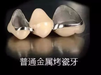 几百块的便宜烤瓷牙好不好可以用吗？