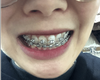 杭州正畸到拔智齿看牙记23周岁