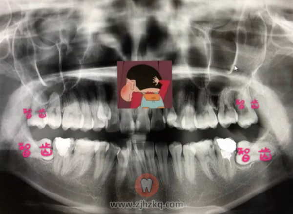 杭州正畸到拔智齿看牙记23周岁