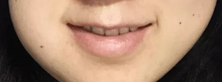 杭州网友拔智齿疼不疼经验分享