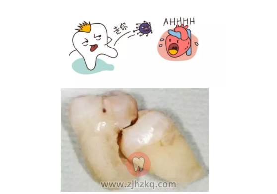 什么是前倾阻生智齿？附图片