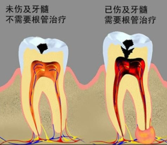 牙齿烂到什么程度要做根管治疗
