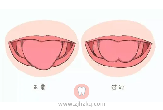 杭州儿童舌系带短及如何治疗系列专题