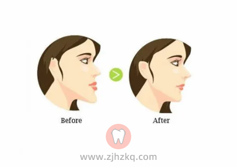 杭州正畸医生推荐戴隐形牙套优缺点是什么？