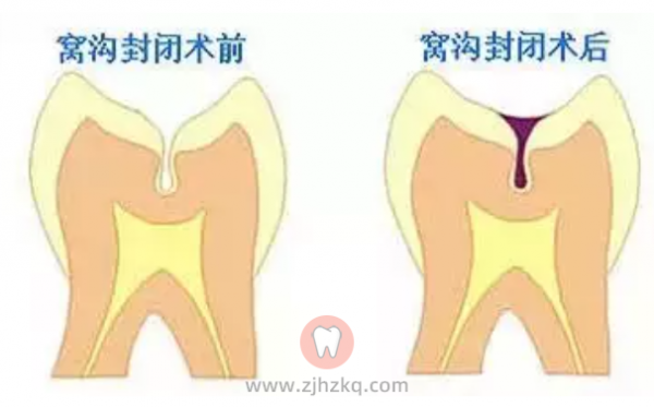 杭州窝沟封闭口腔知识科普
