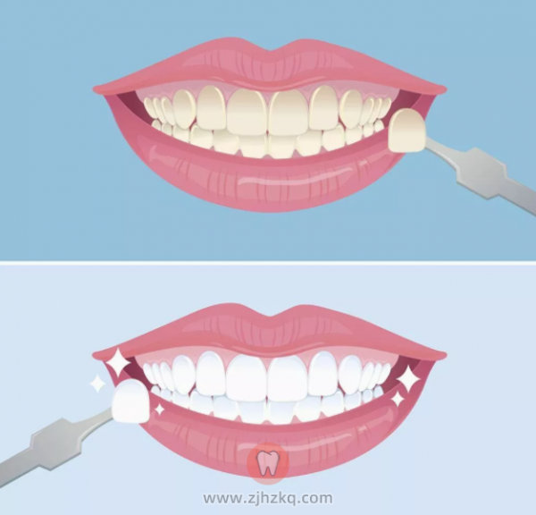 杭州牙齿冷光美白口腔知识科普