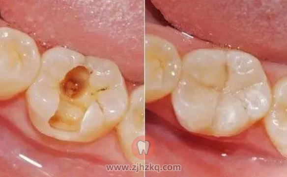 杭州牙齿楔状缺损修复及图片