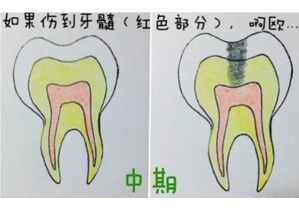 早期龋齿症状图片