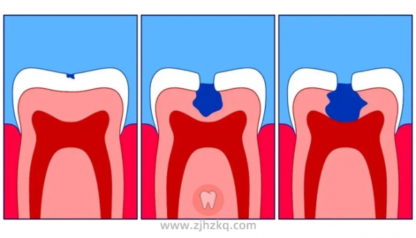 早期龋齿症状图片
