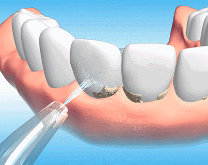 洗牙危害会导致牙齿松动掉落？