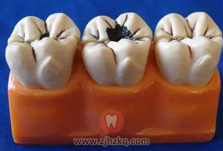 孩子为什么容易长蛀牙