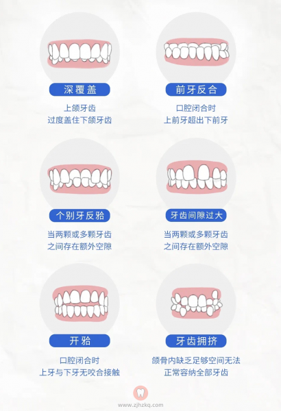 常见牙齿不齐牙齿畸形症状图片