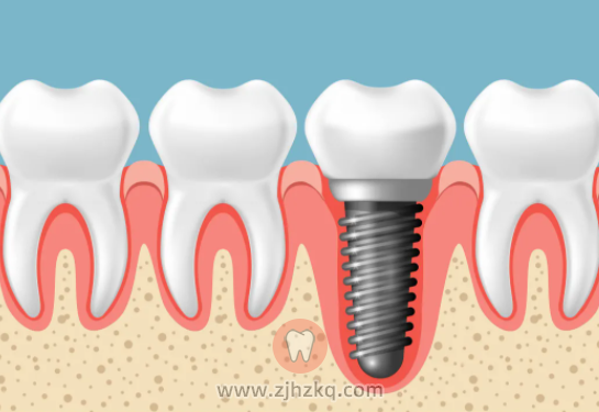 杭州牙科医院种植牙种植体价格