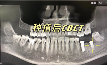 杭州坚果口腔翟强种牙案例