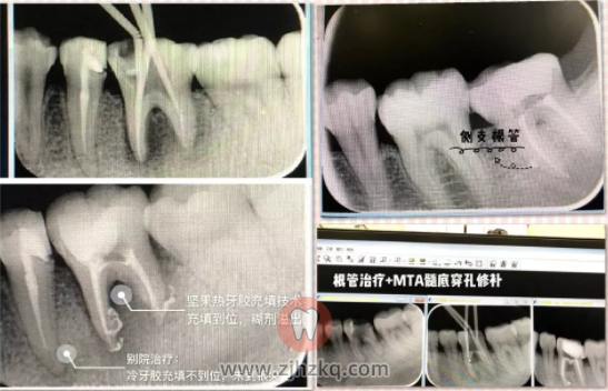 杭州坚果口腔施林峰医生拔牙病例案例