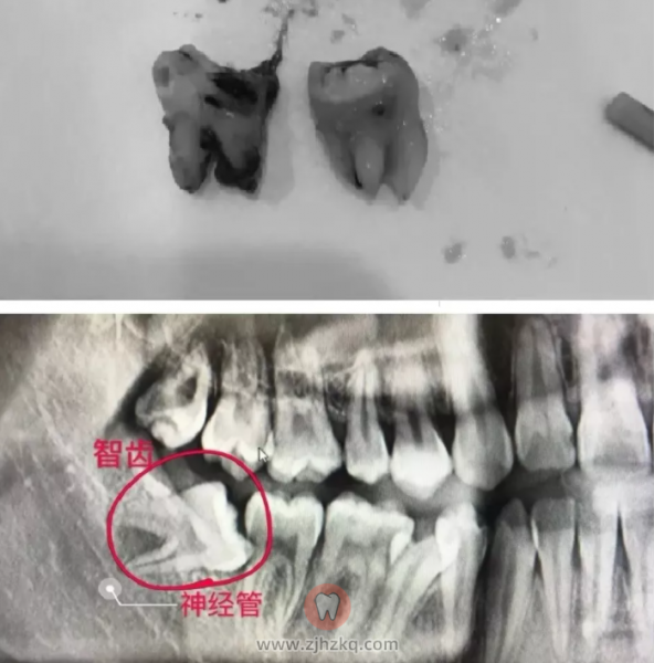 杭州坚果口腔施林峰医生拔牙病例案例