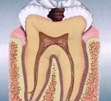 蛀牙阶段图片