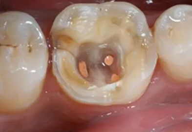 什么时候需要根管治疗？