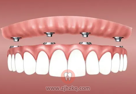 杭州微创舒适种牙