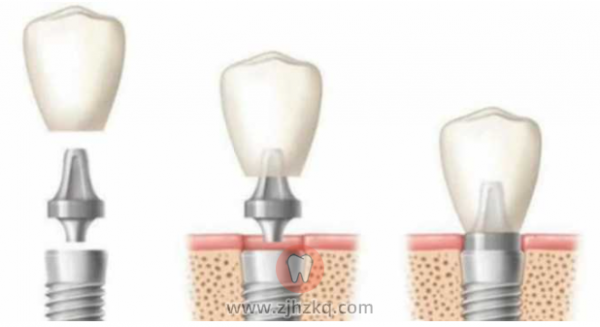 美国皓圣和韩国奥齿泰种植牙哪个好？