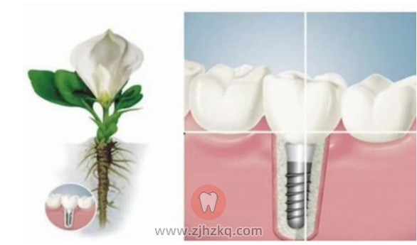 杭州种植牙费用价格表
