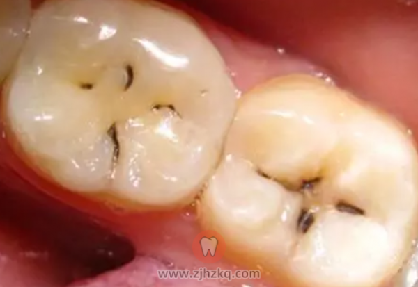 牙齿上有小黑点需要去医院看吗？