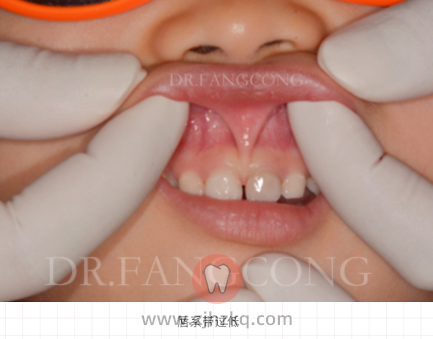 什么是唇系带异常图片