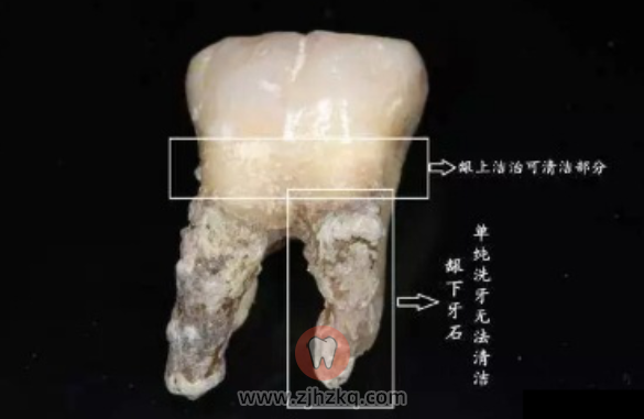 杭州龈下刮治费用