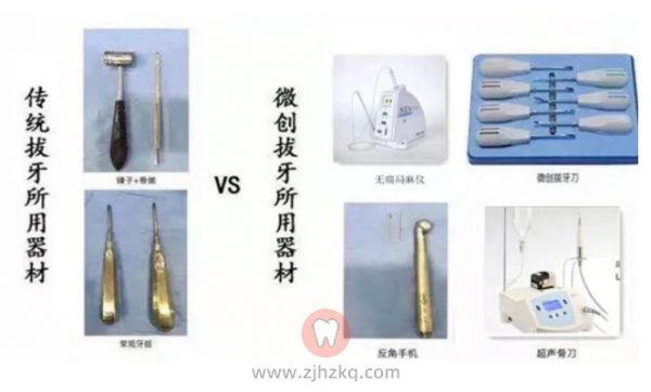 杭州微创拔牙哪里好