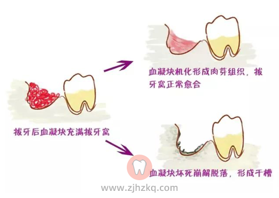 杭州拔智齿干槽症