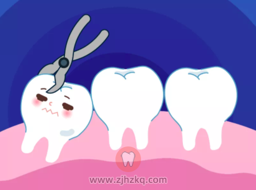 杭州拔牙记：拔牙为啥要花1000多