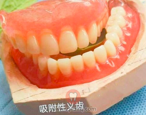 杭州镶满口牙全口假牙价格一般是多少钱