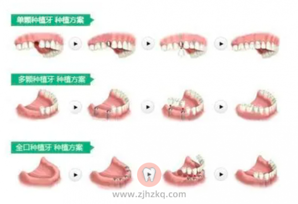 杭州做全口种植牙的价格是多少钱？