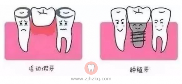 种植牙和假牙有什么区别